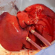 A liver hooked up to the perfusion machine.